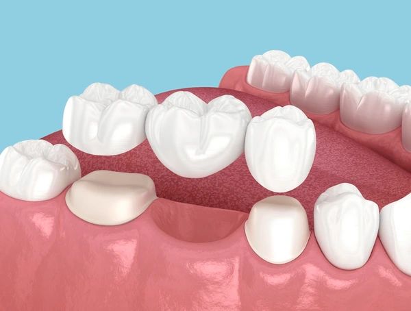 dental bridges in winnipeg, mb