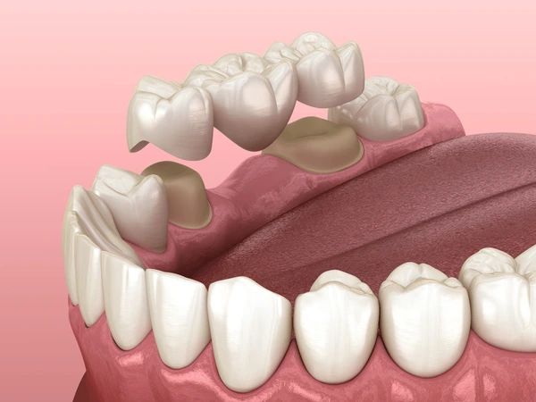 dental bridges near you