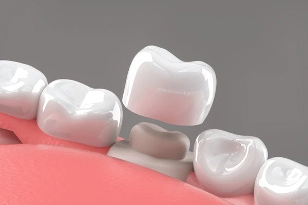 dental crowns in winnipeg, mb