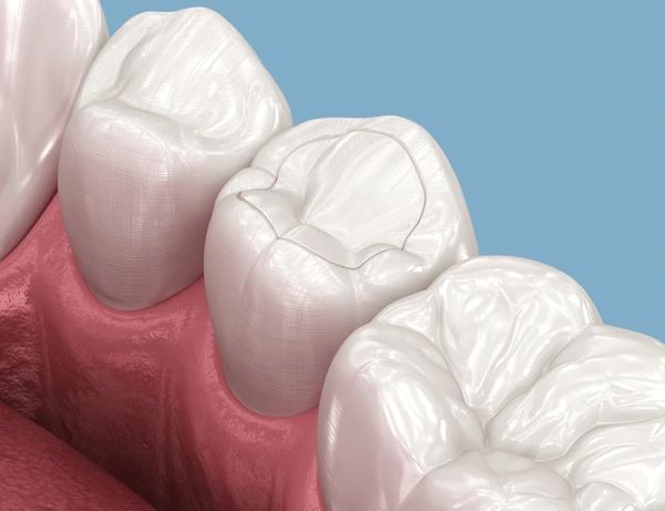 dental fillings near you