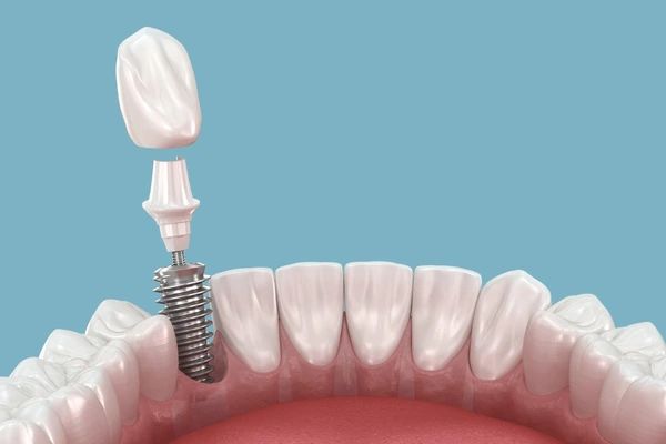 dental implants in winnipeg, mb