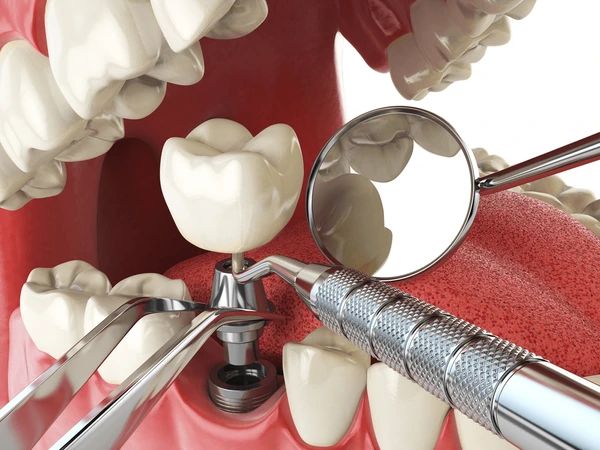 dental implants near you