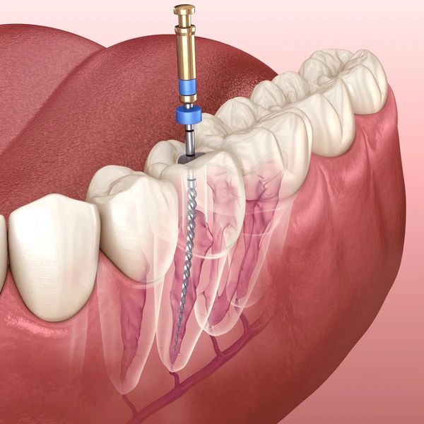 root canal therapy in winnipeg, mb