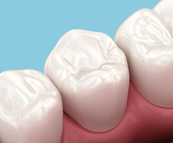 tooth-coloured fillings near you